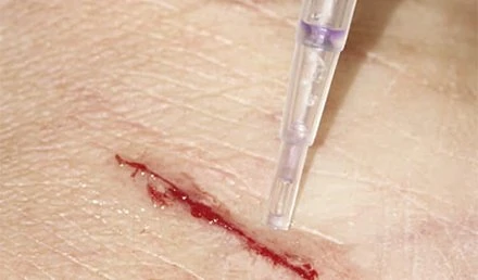 Wound Glue: A Revolution in Wound Care. How to Guide